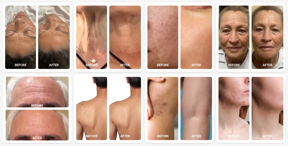 Before and after comparison showing multiple cases of skin improvement after red light therapy, including wrinkles, acne, scars, and pigmentation